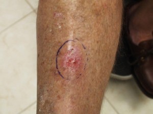 Squamous cell carcinoma