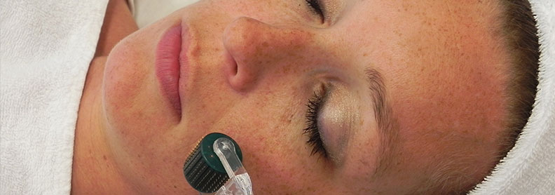 Derma Roller