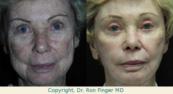 face lift savannah eyelid lift