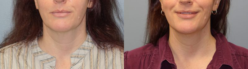 Before-&-After-One-Month-ThermiTight-&-Lipo-of-the-Neck