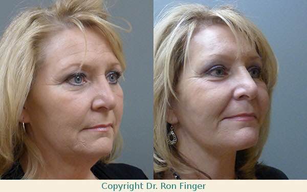 Before and After Modified Face lift, Brow Lift, and upper Eyelid lift.