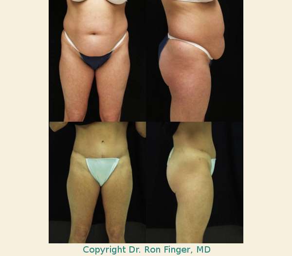 Abdominoplasty andLiposuction of the sides and back