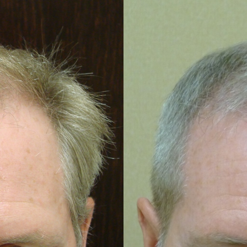 Male Hair Restoration