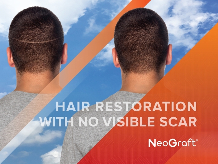 Hair Restoration Savannah