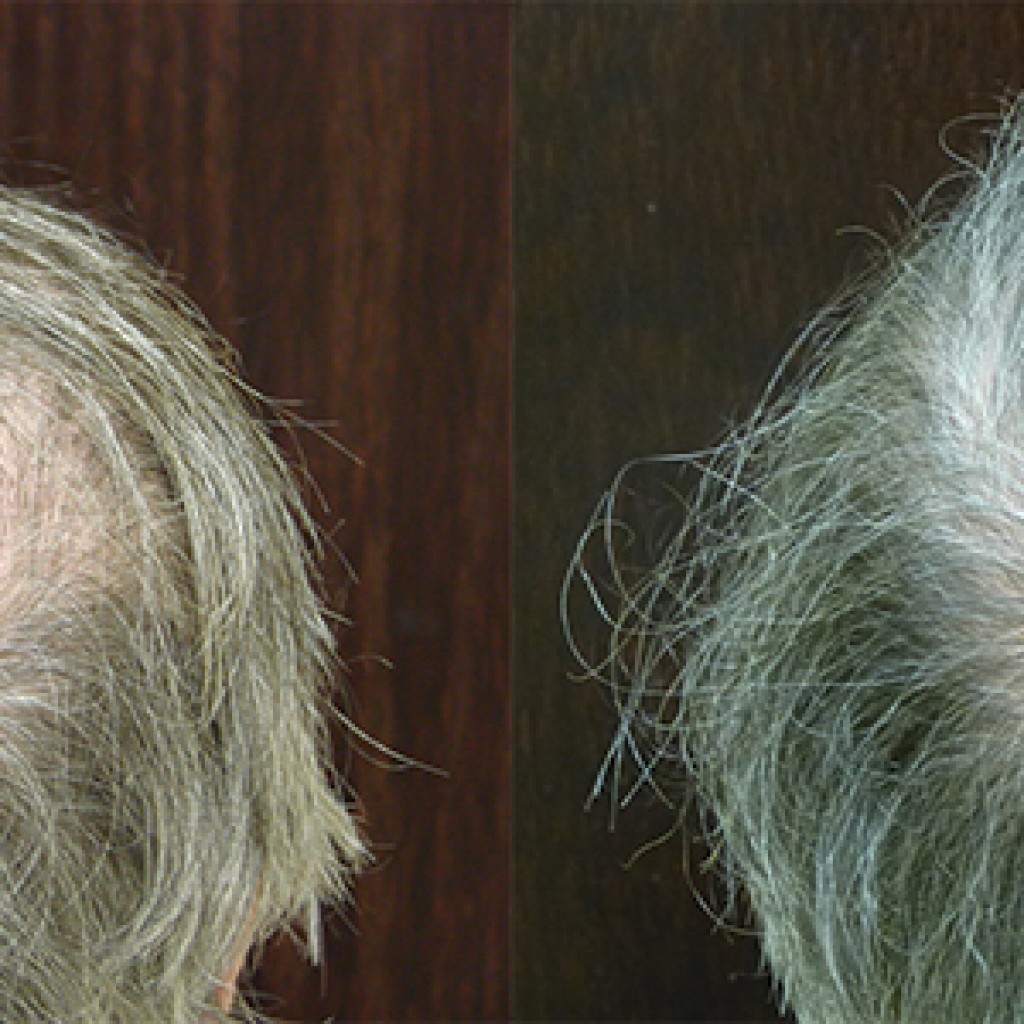Male Hair Replacement Savannah NeoGraft