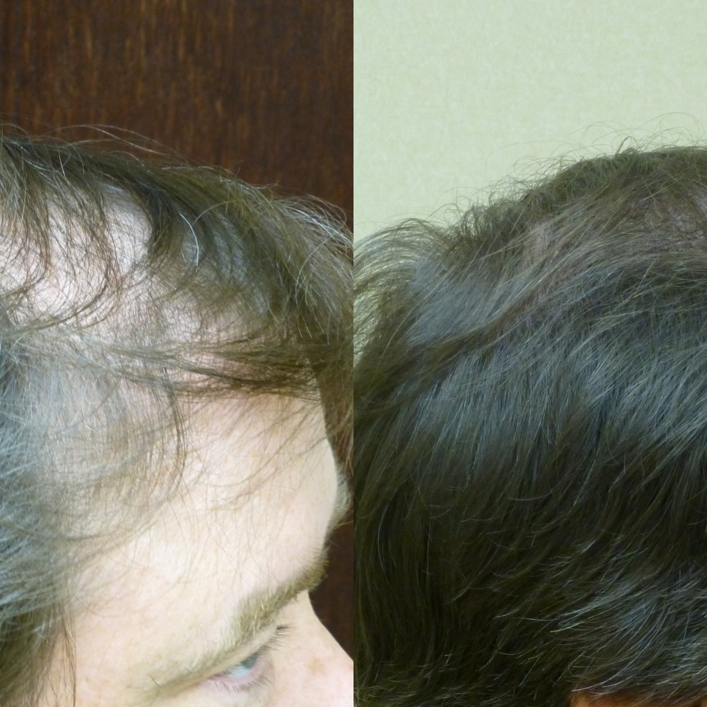Savannah Male Hair Loss Solution