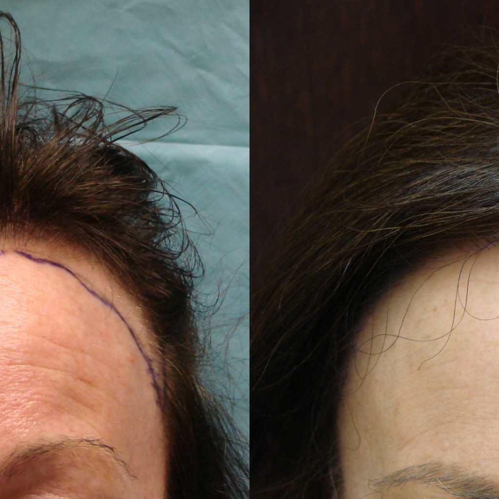 Cost for Neograft is anywhere between $4.50 and $5 nationally