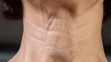 Neck Wrinkles treatment at Finger and Associates