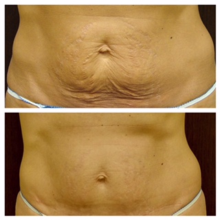 https://www.fingerandassociates.com/wp-content/uploads/2016/02/Before-and-after-loose-skin-removal-of-the-abdomen-.jpg