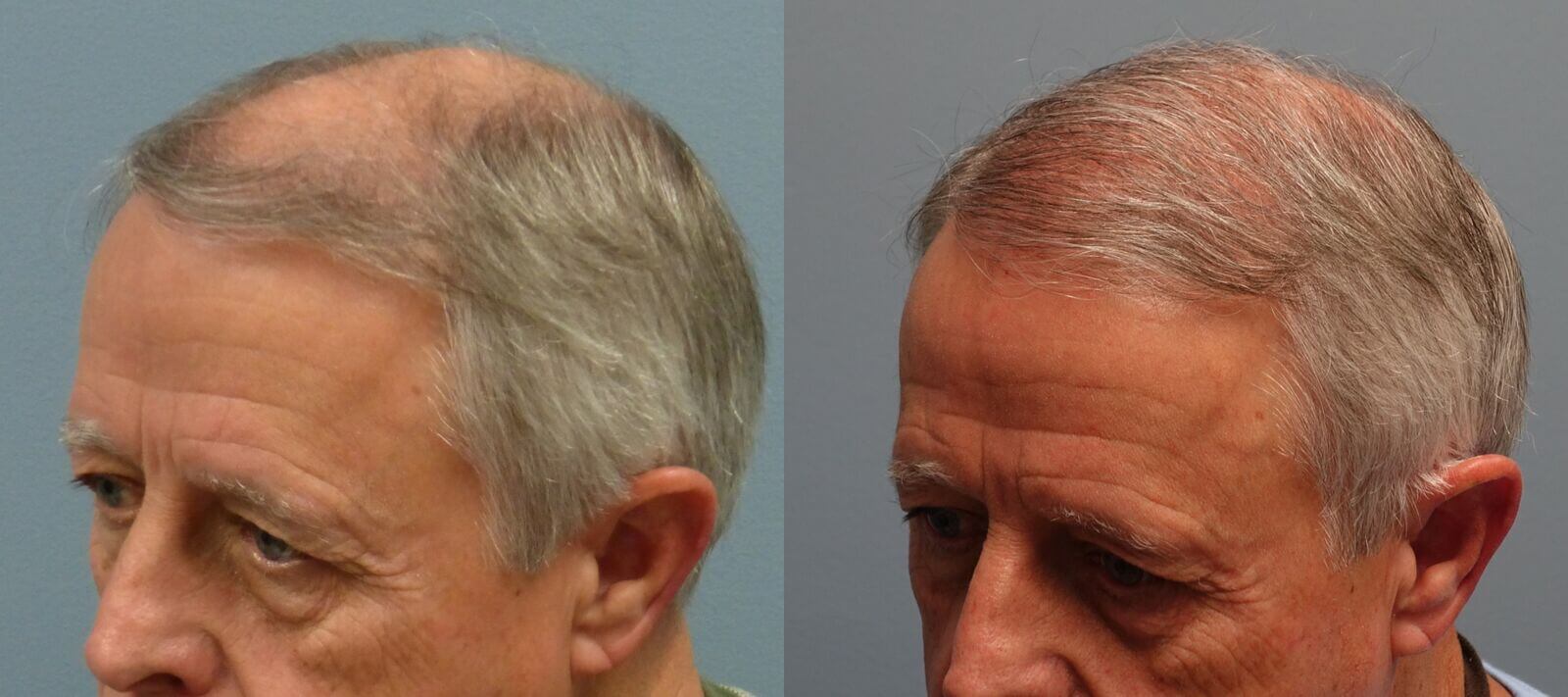 Neograft, 65 year old 2,010 grafts to frontal scalp before and 7 months after