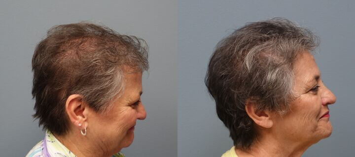 Hair Transplant with Neograft 69 year old 1,325 Grafts Before and 11 months after