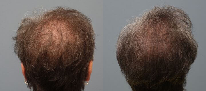 Hair Transplant with Neograft 69 year old 1,325 Grafts Before and 11 months after