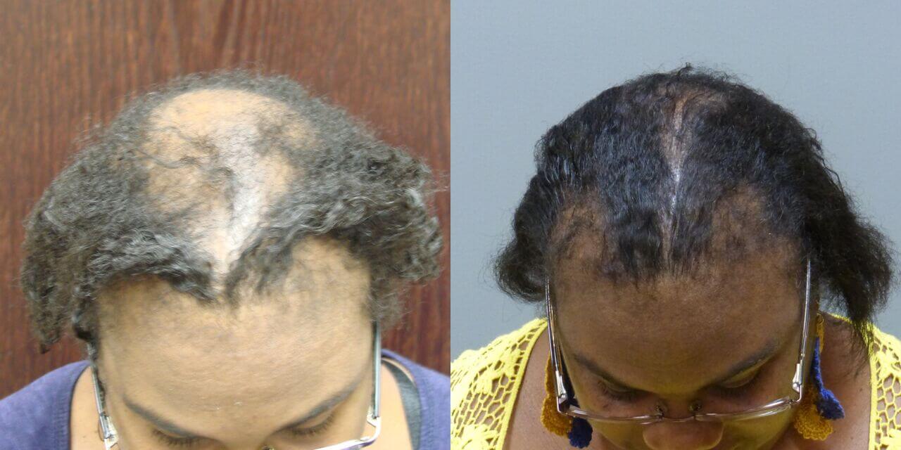 Hair Transplant with NeoGraft 40450 Grafts and Scalp Reduction By Dr. E. Ronald Finger