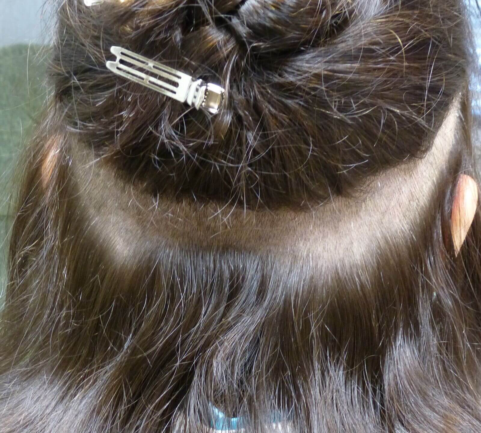 This is an example of a strip excision that is done for patients with long hair. The area is excised and then the edges are sutured back together. This prevents having to shave a large donor site.