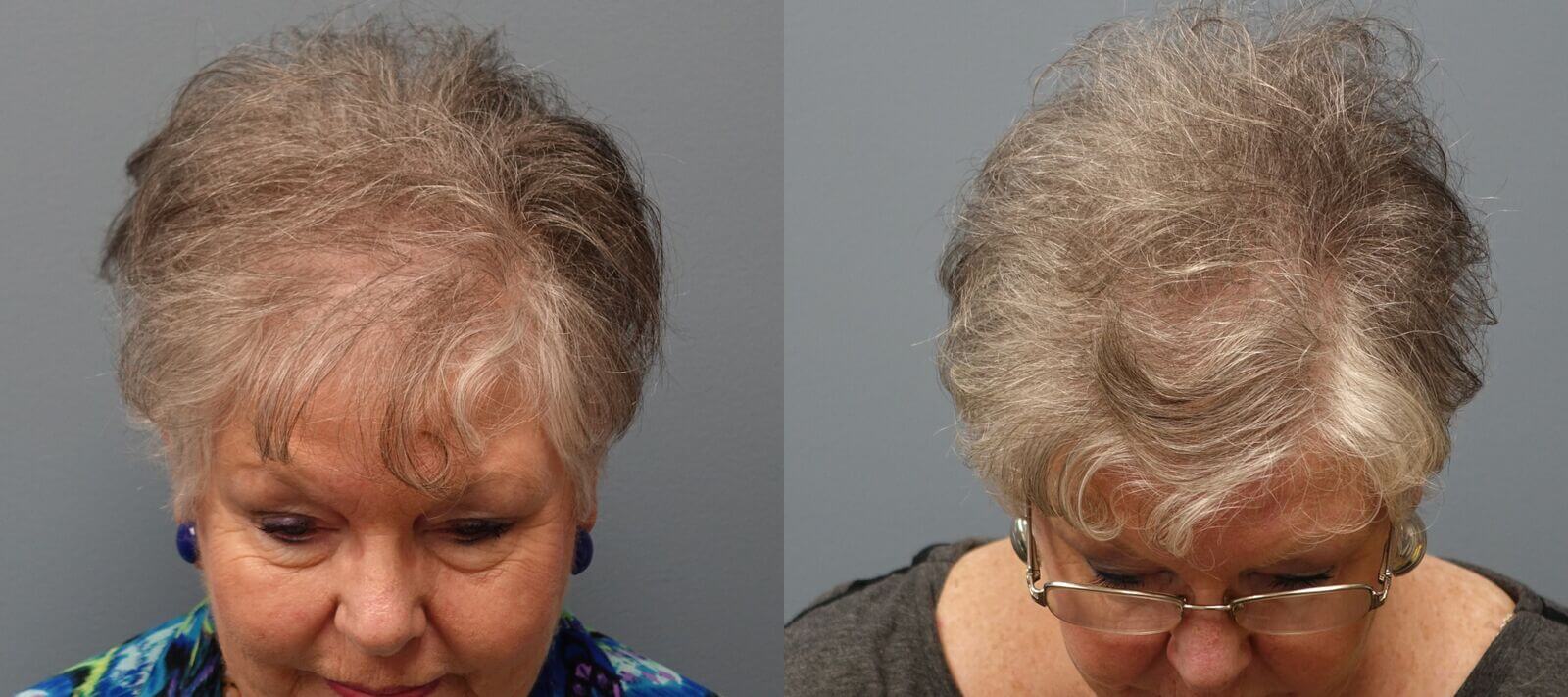 Hair transplant with Neograft 66 year old 1,325 grafts Before and 11 months after