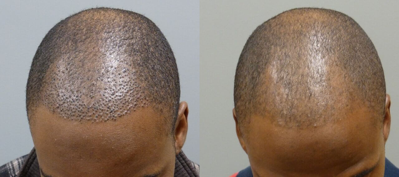 This is an example of a neograft patient, the first set show his donor site and his before picture, the second set shows him 11 days after and then at 4 months after