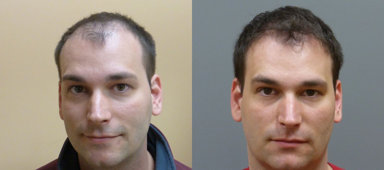 Neograft hair transplant 32 year old 2,000 grafts before and 7 months post-op