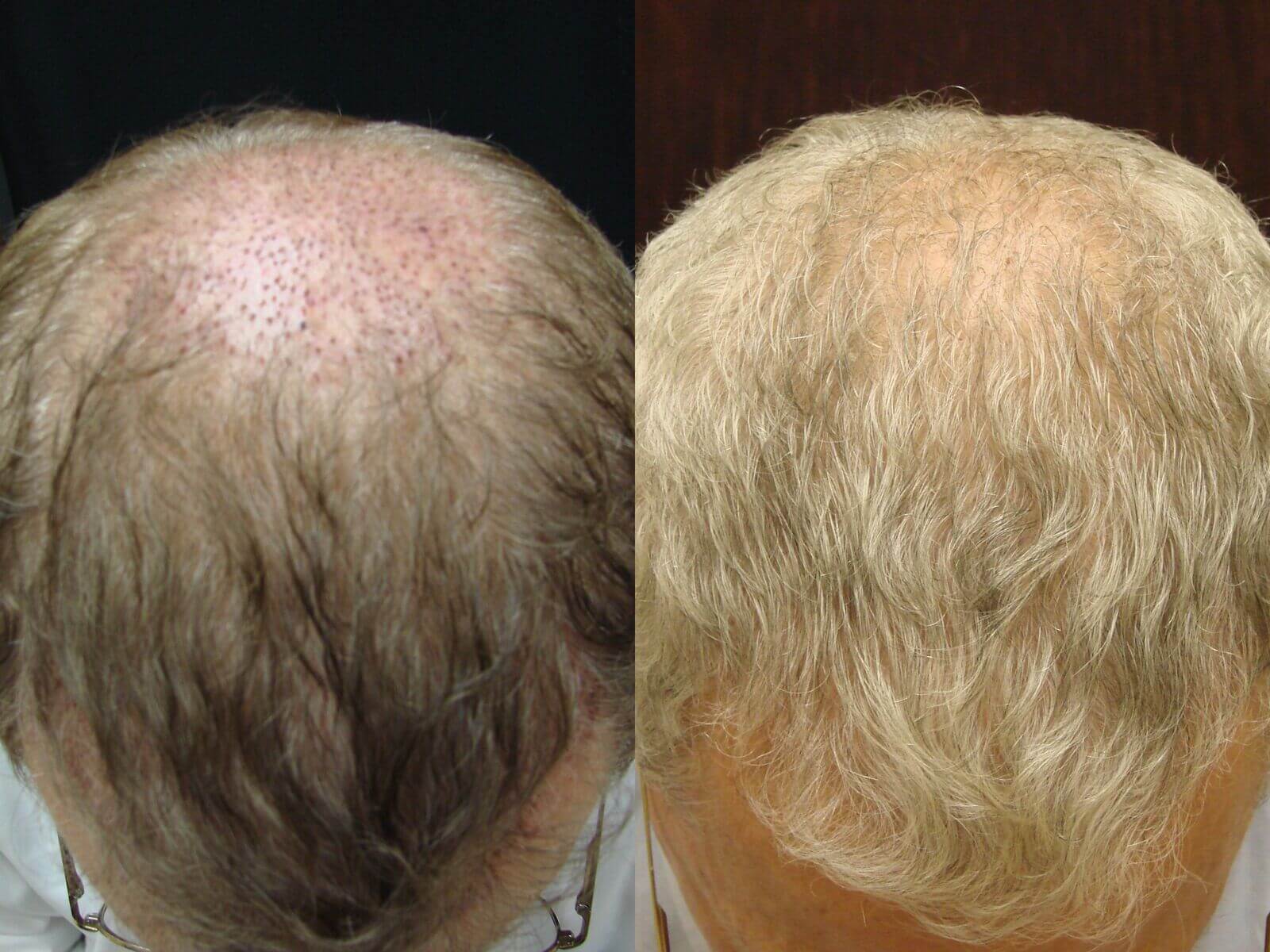 70 year old, 1,000 grafts, before and 8 months after