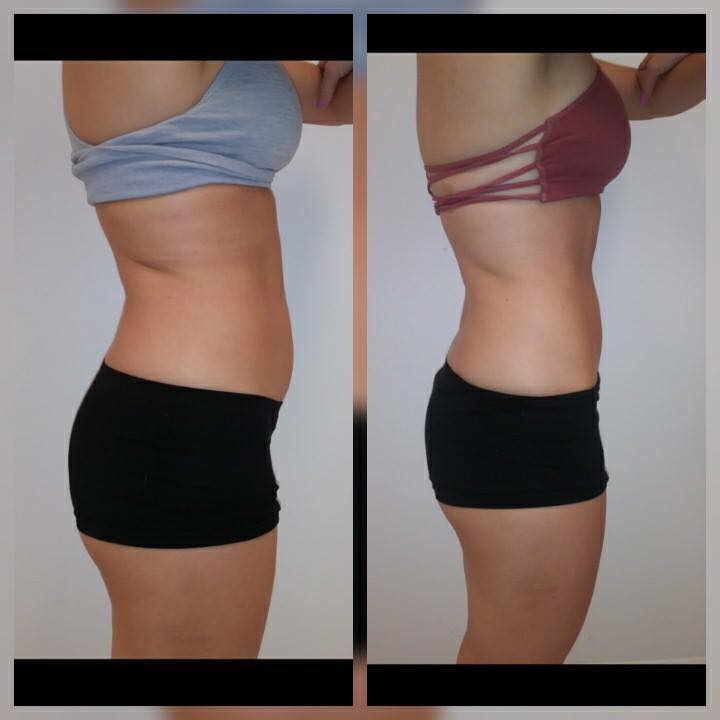 Body Sculpting & Body Contouring  Body Sculpt For Thighs, Waist