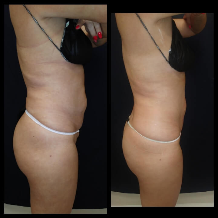 Before and after 2 Posh Body Slim Treatments - Treatment Goal Fat Reduction and Skin Tightening
