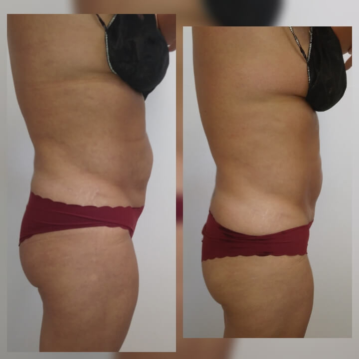 Before and after one Posh Body Slim Treatment for Body Sculpting and Fat Reduction