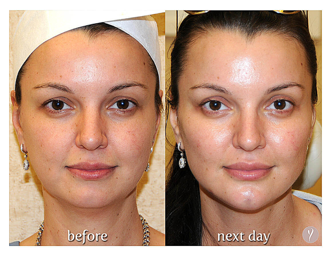 Courtesy of the Y Lift Center. Y Lift before and after.