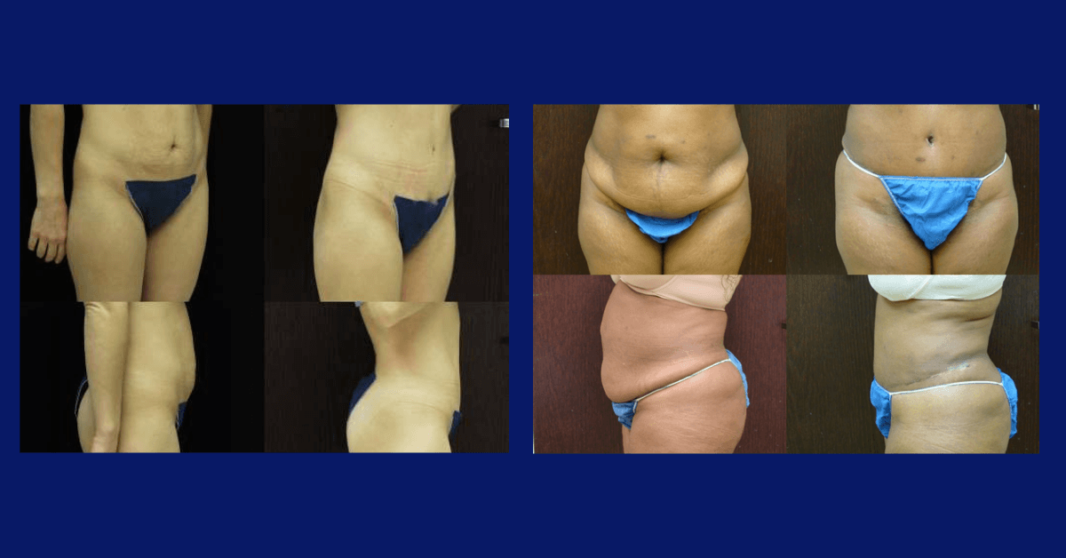 Butt lift procedure (Skin-tightening) - Dr. Rodriguez