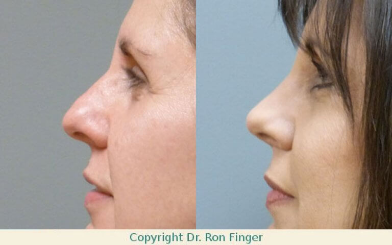 Nose Job Rhinoplasty by Dr. E. Ronald Finger
