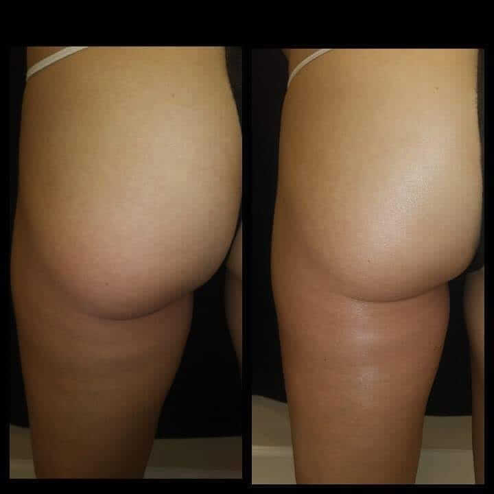 Posh body slim for lifting and toning the buttocks works by using RF technology without the ultrasonic cavitation.