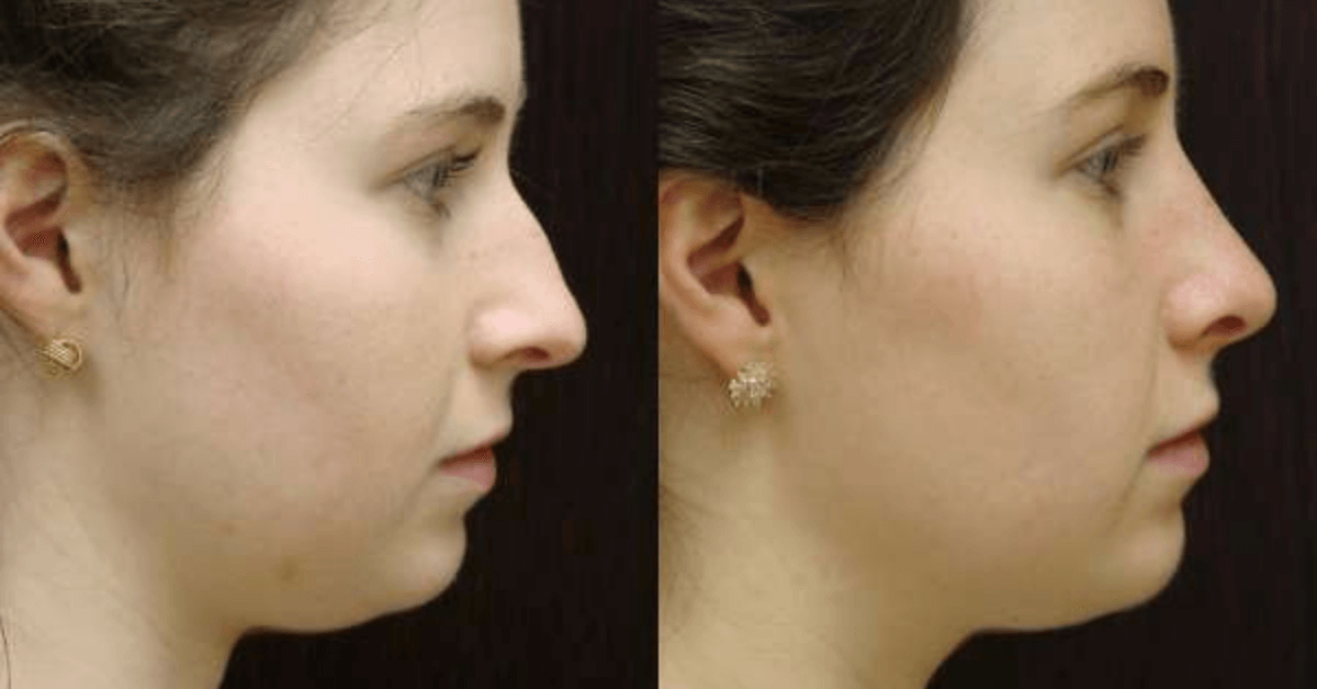 Nose Job by Dr. Finger- Savannah Rhinoplasty- Skilled Surgeon