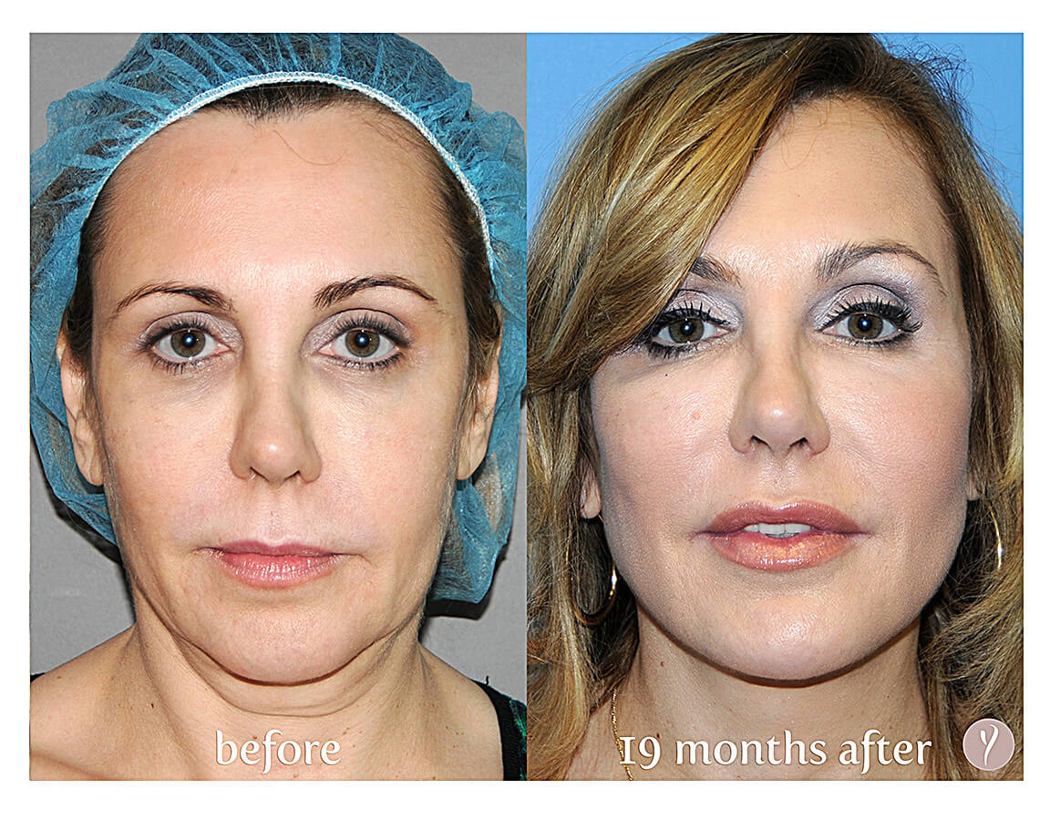 Experience The Latest Nonsurgical Facelift The Y Lift - Savannah, Georgia- by Dr. Finger
