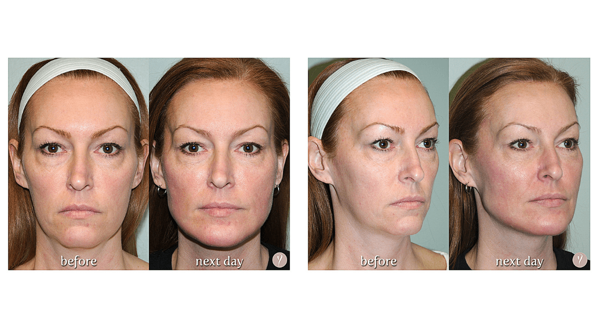 Experience The Latest Nonsurgical Facelift The Y Lift Savannah