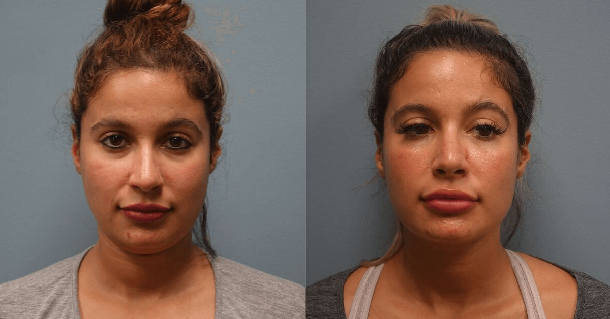 Before and After secondary Rhinoplasty with cartilage repair.