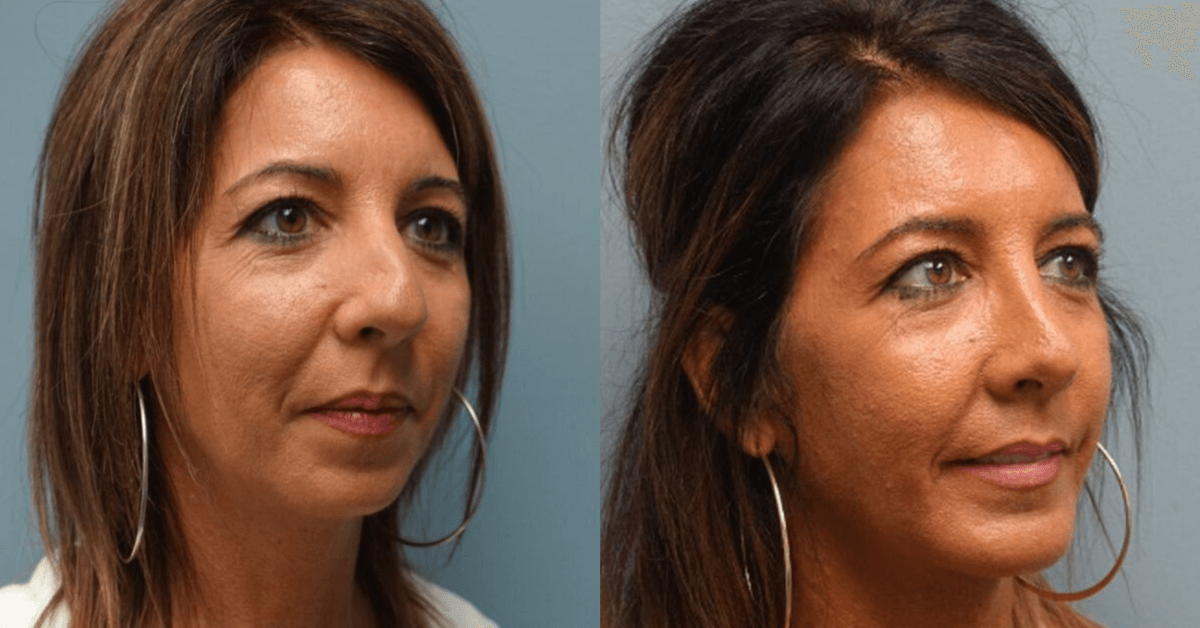 Before and After 4-months Rhinoplasty/Septoplasty & Chin Implant