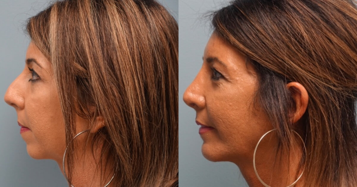 Before and After Rhinoplasty and Chin Implant