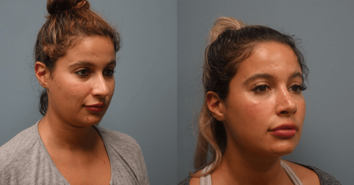Before and After secondary Rhinoplasty with cartilage repair