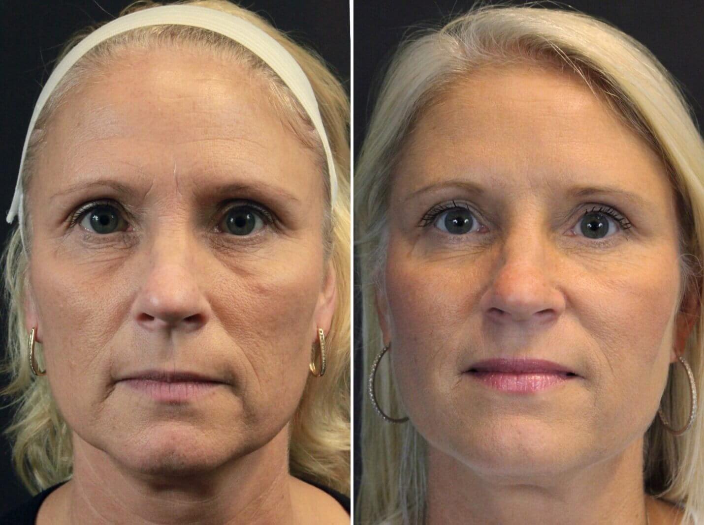 Silhouette Instalift Results are simply amazing for the right candidate - Patient before and after courtesy of instalift.com