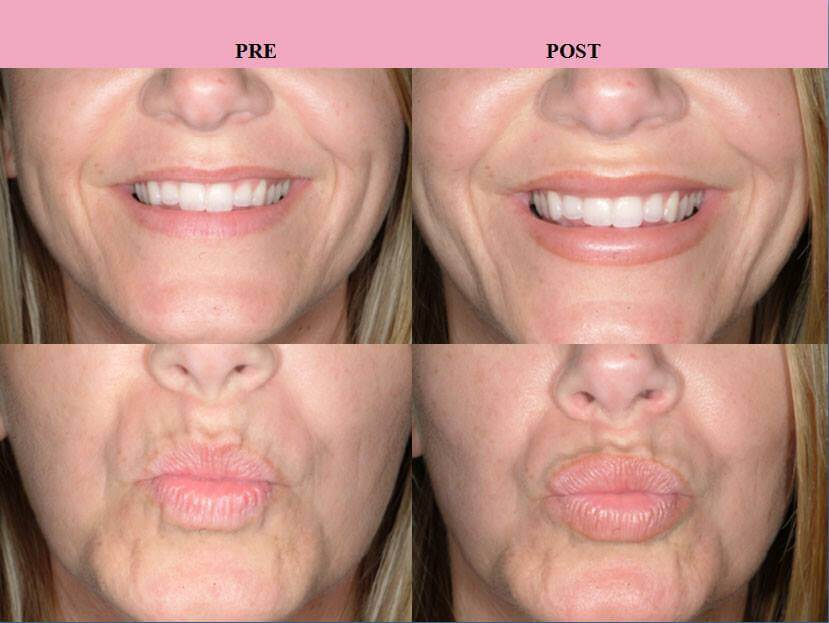 Before and After Juvederm Injections by Dr Finger in Savannah Georgia and Bluffton SC
