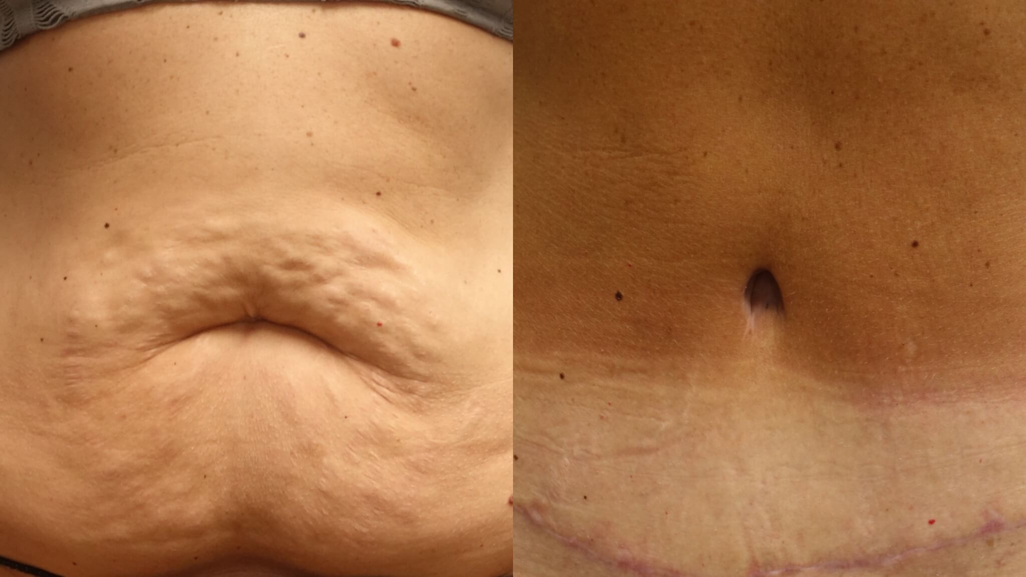 Beautiful Belly Button after Tummy Tuck by Dr. E. Ronald Finger
