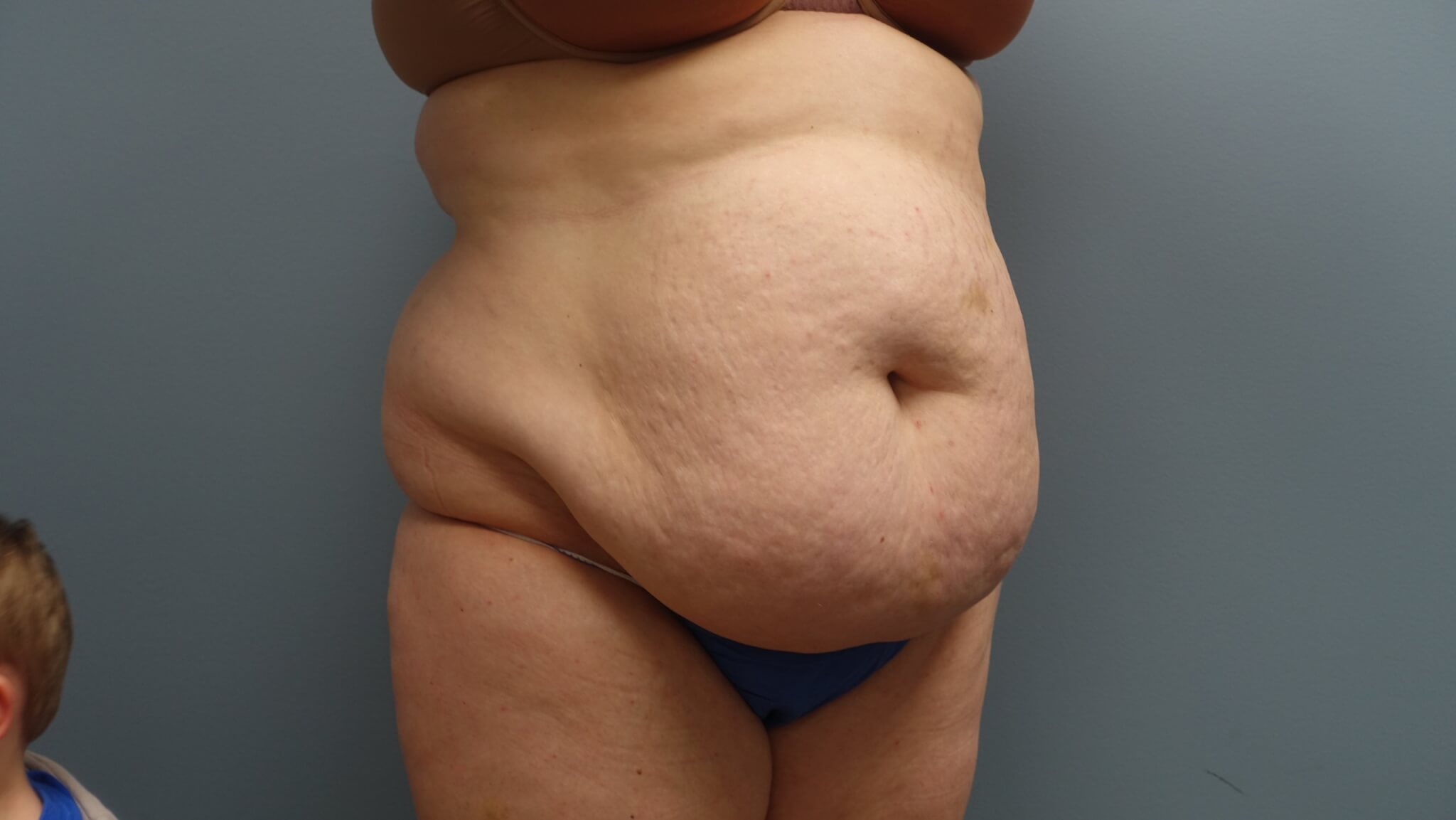 Before Tummy Tuck, Liposuction and Muscle Repair