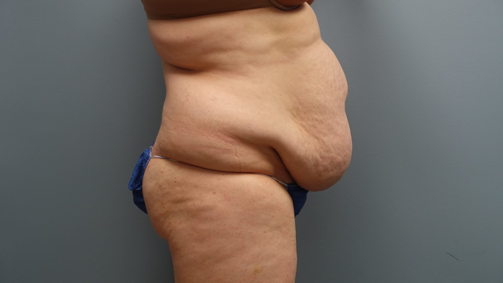 Before Tummy Tuck with Liposuction and Muscle Repair