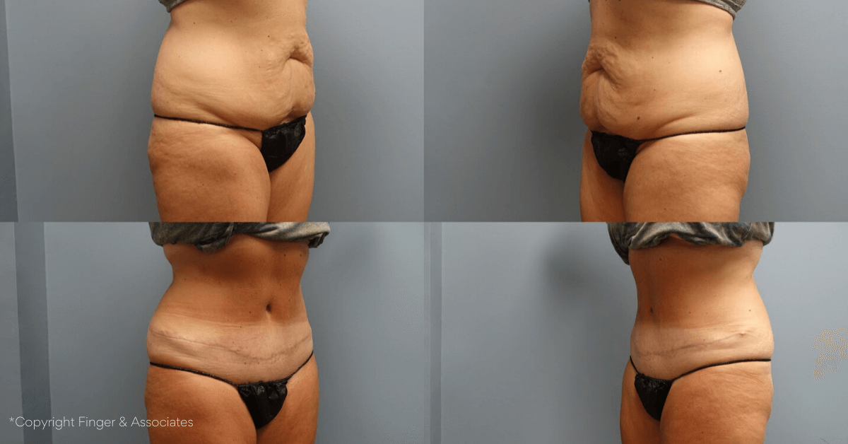 Before and After 4-months Tummy Tuck without Drains by Dr. E. Ronald Finger