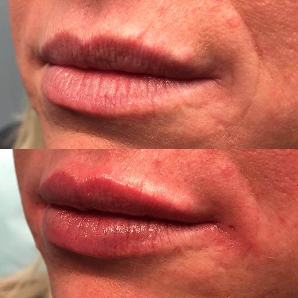 Before and after Restylane Kysse for Lips by Nurse Dallas Sellars
