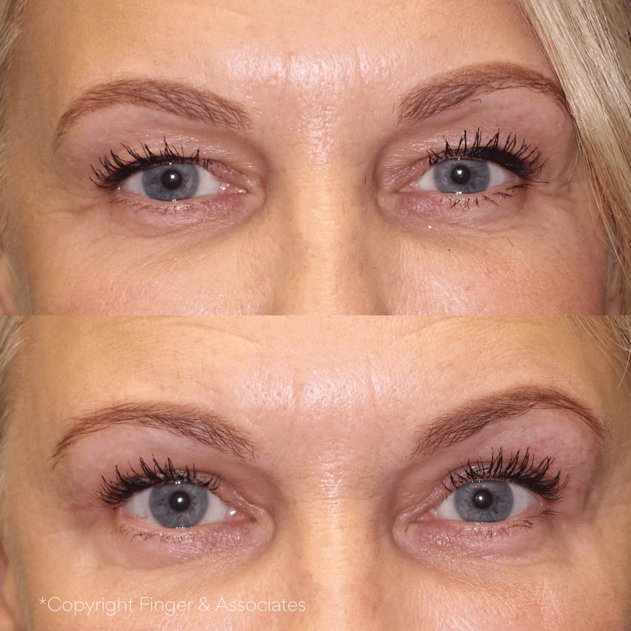 Before and after 4-month of receiving Blepharoplasty - upper eyelid lift