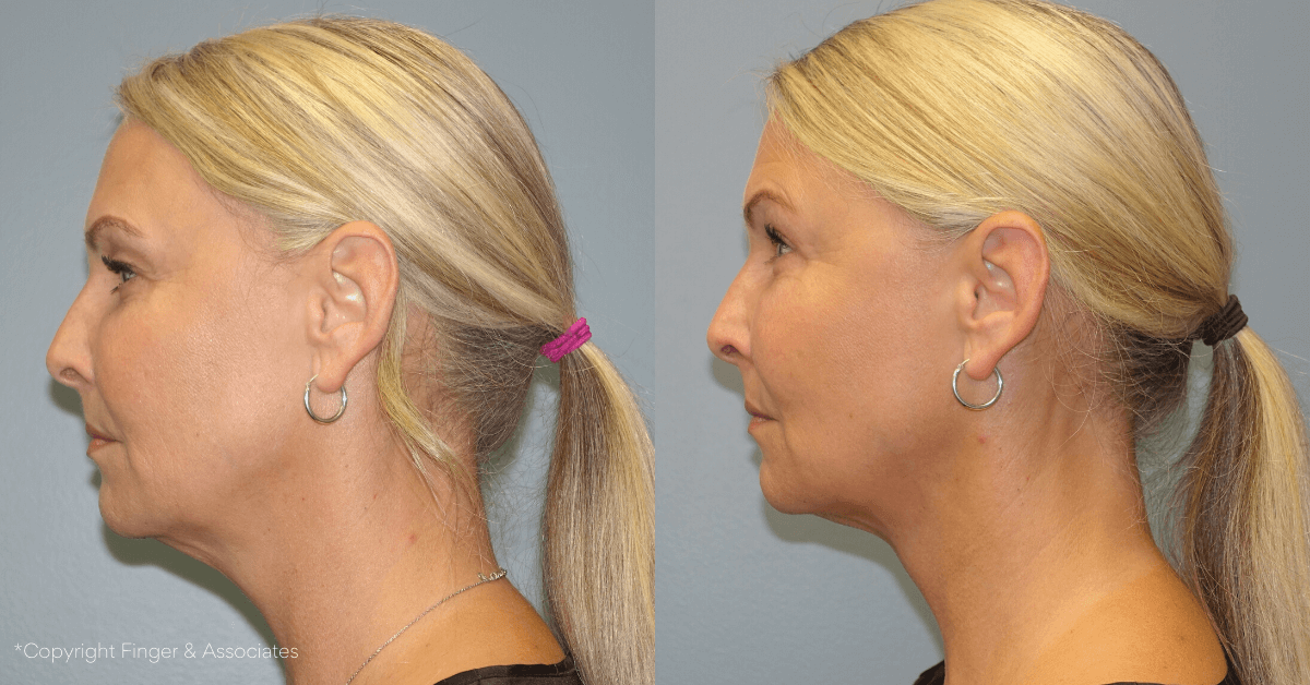 Before and After Lipo of Lower Face and Neck + Renuvion for Skin Tightening