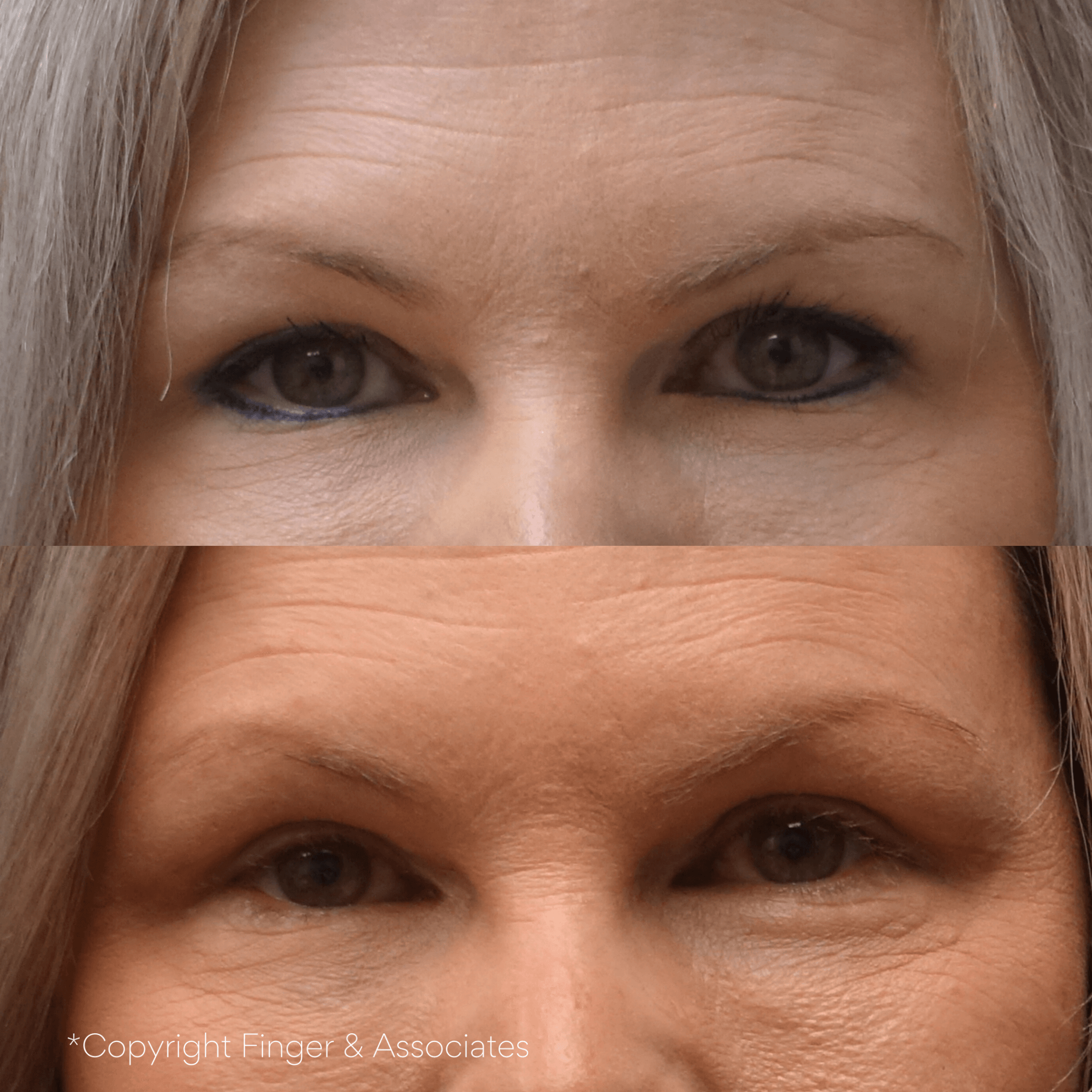 Before and After Upper Eyelid Lift (Blepharoplasty) one month still healing