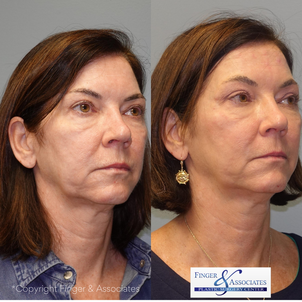 Before and after 4-months of receiving the Silhouette Instalift by Dr. E. Ronald Finger - The results will continue to improve over several months to come.