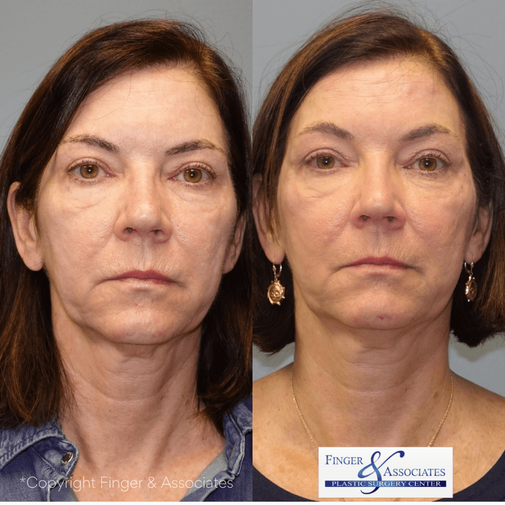 Before and after 4-months of receiving the Silhouette Instalift by Dr. E. Ronald Finger - The results will continue to improve over several months to come.