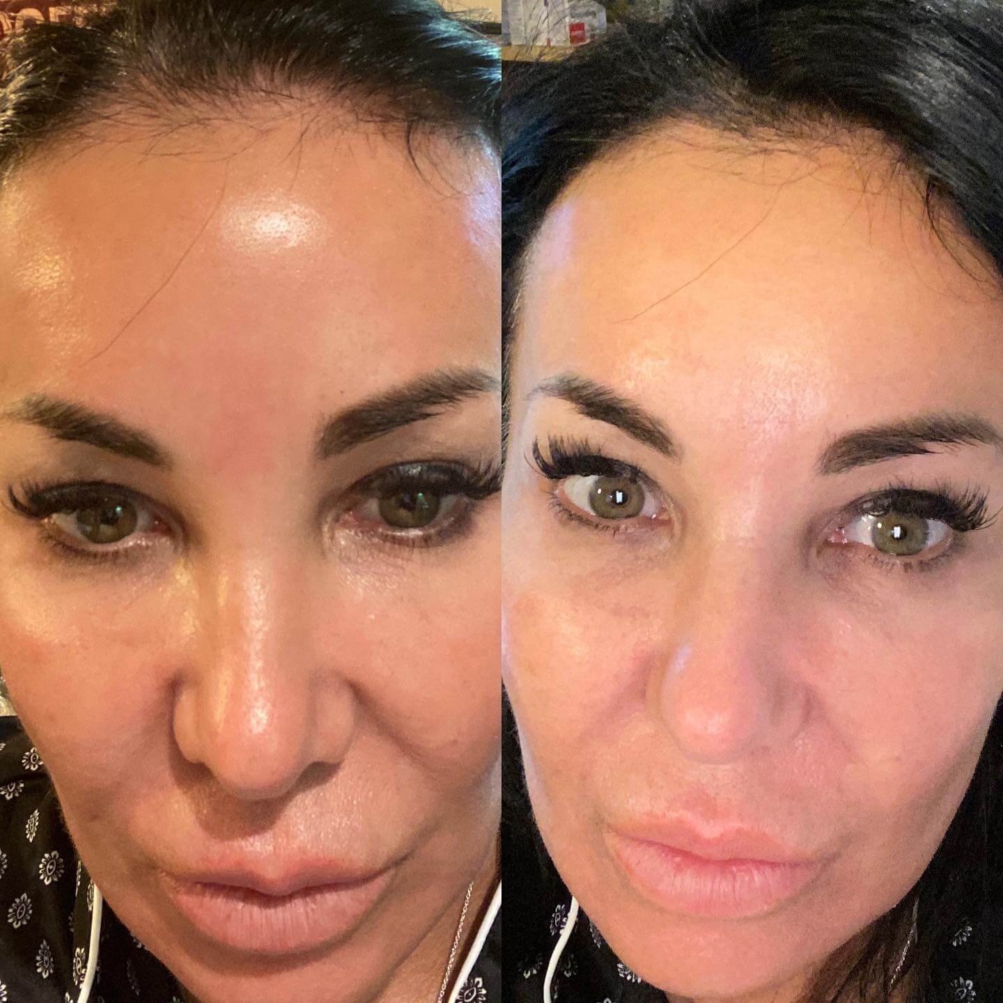 Before and After Coolpeel Treatment offered by Dr. Finger in Savannah