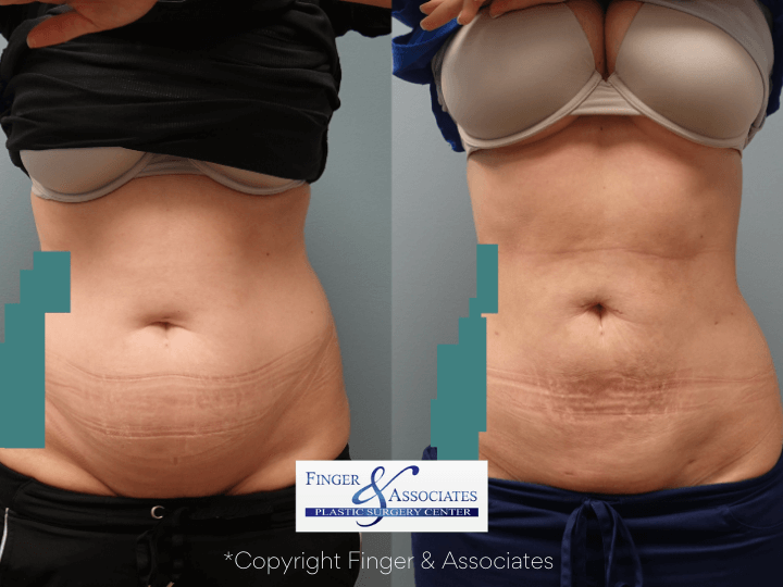 Before and after 3-months of Liposuction on abdomen and hip rolls plus Renuvion for Skin Tightening